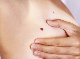 melanoma